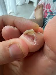 Image result for Onychotillomania feet