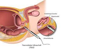 Check spelling or type a new query. Urologe Region Hannover Prostatauntersuchung Urologe Region Hannover Urologe Region Hannover