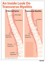 Transverse myelitis may occur alone or in combination with disease elsewhere in the nervous system. Transverse Myelitis