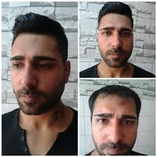 Ahi Protez Sac Home Facebook