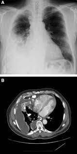 Solid, glandular, and/or tubulopapillary patterns were observed in the pure epithelioid mesotheliomas or the epithelioid component of the biphasic mesotheliomas. Sarcomatoid Mesothelioma With Osteoid Differentiation Journal Of Thoracic Oncology