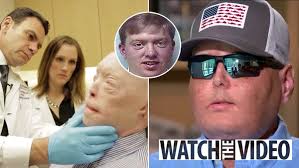 Firefighter who had the world's most extensive face transplant says he'd  run into the blaze again five years after op