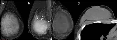 Other benign (eg, fibroadenoma) or malignant lesions of the . Frontiers Differentiation Between G1 And G2 G3 Phyllodes Tumors Of Breast Using Mammography And Mammographic Texture Analysis Oncology