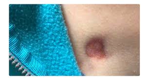 Image result for Dermatofibrosarcoma Protuberans