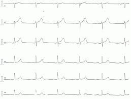 In myocarditis, ecg is an asset to find out abnormal heart rhythms. Pericarditis Myocarditis Perimyocarditis Ecg Criteria Treatment Ecg Echo
