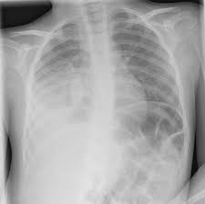 Spoken pronunciation of chest in english and in tamil. Air Space Opacification Radiology Reference Article Radiopaedia Org