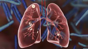Later, it often causes coughing, wheezing, and chest pain. What Are Lung Nodules Northwestern Medicine