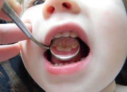 Kita selalu biarkan anak terlena dengan botol susu masih dimulut kan. Karies Botol