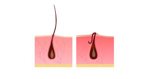 كيفية إزالة الشعر تحت الجلد ويب طب
