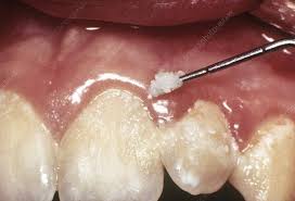 Locate plaque using a stain. Can I Use A Toothpick To Remove Plaque From My Teeth Quora