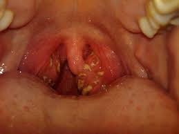 Home remedies that can be used to get rid of the white spots and the pus from your tonsils include: Tonsillitis