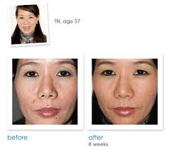 Got breakouts? Enter to win the TRIA Skin Clarifying System worth $375!