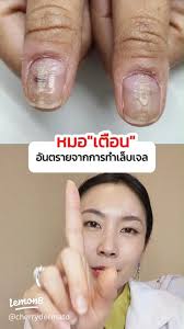 เชื้อราเล็บจากเล็บเจล: วิธีป้องกันและรักษา