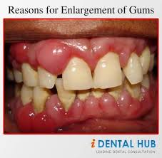 Bleeding gums or gums that are swollen are an early sign of gum disease, also typical symptoms of gingivitis include red, swollen gums, gum tenderness, bleeding gums, and persistent bad breath. Increase In Size Of Gums Is Known As Gingivitis Initially Term Gingival Hypertrophy Or Gingival Hyperplasia Was Swollen Gum Gum Treatment Gum Disease Remedies
