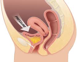 Diagram Showing The Pressure Necessitating A Urethral Sling Procedure Stress Incontinence Urinary Incontinence Incontinence