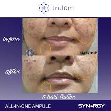 See more of trulum skincare ireland on facebook. Jual Trulum Skin Care Di Pekanbaru