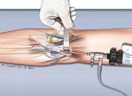 Image result for Biceps Tendon Injection