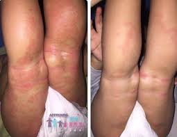 L Eczema De Bebe Quand Pourquoi Comment Apprends Moi Ummi