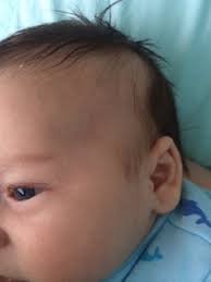 Talk with your child's doctor. Cradle Cap Shampoo Made His Hair Fall Out Babycenter