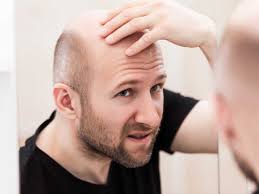 Special helichrysum italicum & oil edition from italy: Hair Loss Treatment Medicines For Hair Fall And Hair Regrowth Times Of India