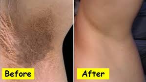 ‫بهترین روش برای رفع تیرگی زیر بغل و کشاله ران چیست ؟ + دلایل ایجاد آن | میس  و مستر‬‎