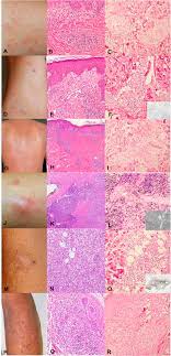 Angioimmunoblastic t cell lymphoma microenvironment. Cutaneous Angioimmunoblastic T Cell Lymphoma Epstein Barr Virus Positivity And Its Effects On Clinicopathologic Features Journal Of The American Academy Of Dermatology