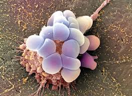 Pictures show the symptoms, tests, and treatments for ovarian cancer, as well as what factors raise your risk for the disease. Fertility Hope For Ovarian Cancer Patients Columbia Magazine