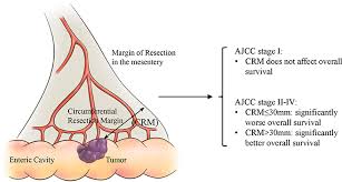 This rim is called a margin. Frontiers The Circumferential Resection Margin Is A Prognostic Predictor In Colon Cancer Oncology