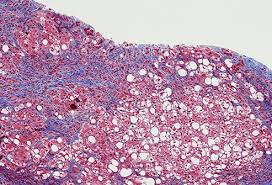 Scarring of the whole liver that makes it shrunken and hard. Cirrhosis Of The Liver Symptoms Treatment Diet Life Expectancy