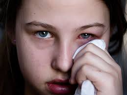 Pink Eye Or Allergies Causes Symptoms And More