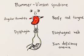In case of significant obstruction of the esophageal lumen by esophageal web and persistent. Katherina Baranova On Twitter Here S My Handy Dandy Visual Mnemonic For Plummer Vinson Syndrome I Like To Imagine Someone Trying To Eat A Beef Steak But It Gets Trapped In A Web