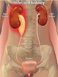 Infected Kidney Remedies Home Health Remedies Remedies For Kidney Infection Health Remedies