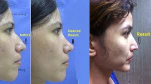 It depends on the changes that we have to perform for getting the perfect shape. The Dark Side Of Cosmetic Surgery In Thailand Bbc News