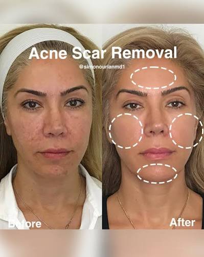 Acne scar removal improves skin texture, smooths pitted scars, and reduces  discoloration—helping restore clearer, more even-looking skin. Using  advanced laser resurfacing and regenerative techniques, this treatment  targets acne scars, dark spots, enlarged