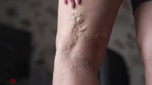 É chamado um trombo ao coágulo que retém os glóbulos vermelhos e obstrui os vasos sanguíneos. Varicose Veins On Woman Legs Indoors Vascular Health Problem Trombose On Female Legs By Troyanpx