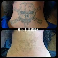 A few amateur tattoos have very deeply placed ink, and this very deep ink can require more treatments. How Many Laser Treatments Does It Take To Remove A Tattoo