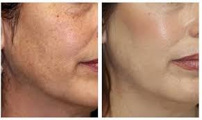 Buy the innovative microdermabrasion device online. Microdermabrasion Moglichkeiten Und Effekte Vorher Nachher