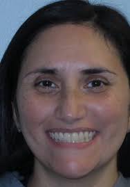 Orthodontic Before & Afters in Leander, TX