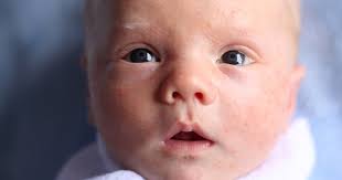 Acné Du Nourrisson : Que Faire Quand Bébé A De L'acné ? - Magicmaman.com