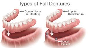 If you type in tooth extraction near me on bing or google, you will likely generate a list of results including general or family dentists in kitchener as well as oral surgeons in kitchener. Palateless Snap On Dentures Snap In Dentures Cost Near Me