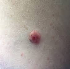 Asymmetry, border, color, diameter, elevation. Disease Management Nonmelanoma Skin Cancer