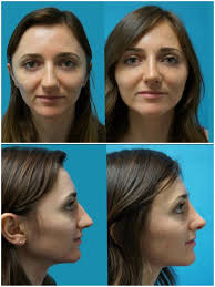 Rhinoplasty Surgery Center of Chattanooga