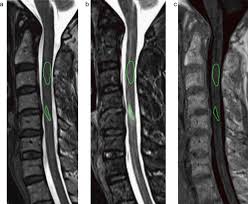 The journal for your research in the following areas: Comparison Of Mri Sequences For Evaluation Of Multiple Sclerosis Of The Cervical Spinal Cord At 3t European Journal Of Radiology