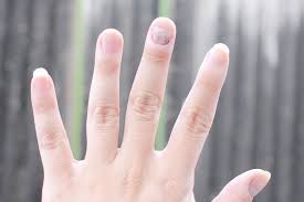 Kurap di pangkal paha adalah jangkitan yang disebabkan oleh kulat (dermatophytes), yang dikenal di bidang perubatan sebagai tinea cruris. Cara Merawat Kurap Kuku Pada Kehamilan Kehamilan 2021