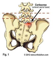 Asymmetrical Hips And Uneven Legs Walking Silly Putty Psoas Release Pressure Point Therapy Scoliosis Exercises