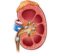 Kidney Stone Clinic