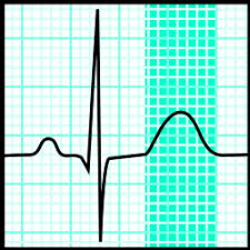 Image result for T Wave