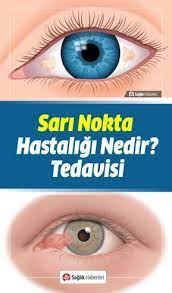 Sari Nokta Hastaligi Nedir Hangi Yaslarda Gorulur Belirtileri Ve Tedavisi Goz Sagligi Gozler Akupresur Recete