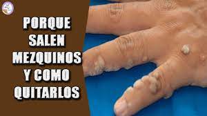 Porque Salen Los Mezquinos Y Como Quitarlos Youtube