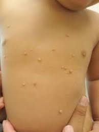 Maybe you would like to learn more about one of these? Expert Shares Treatment Tips For Molluscum Contagiosum And Warts Mdedge Pediatrics